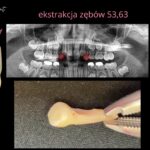zęby mleczne (6)
